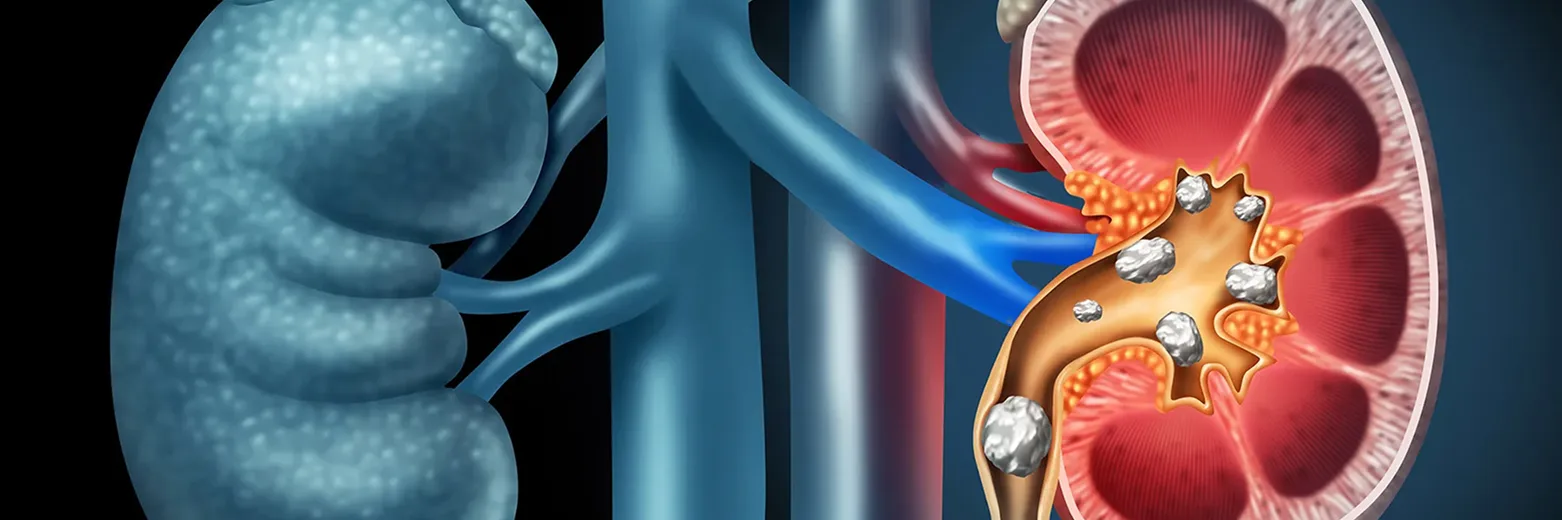 Kidney stone anatomy illustration