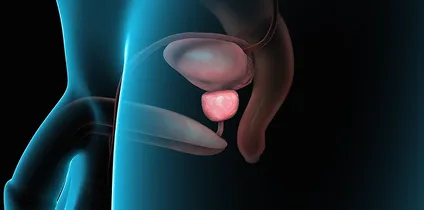 BPH vs Prostate Cancer - What Every Man Over 50 Should Know