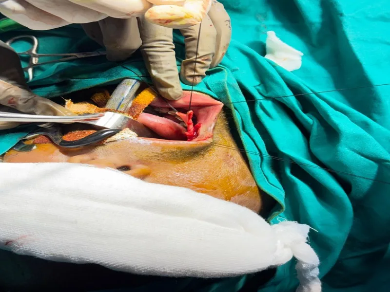Urethroplasty surgical field - graft sutured at Urocare Hospital Gondia