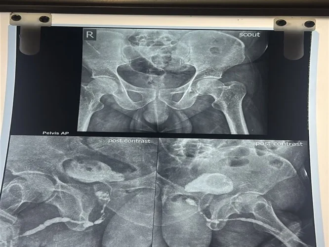 Retrograde urethrogram showing pan-urethral stricture - Urocare Hospital Gondia