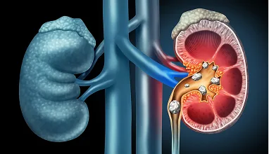 Kidney Stone Treatment - Urocare Hospital Gondia