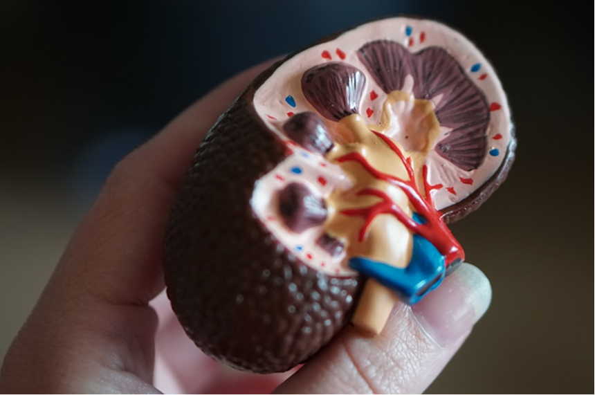 Kidney stone anatomical model showing stone formation