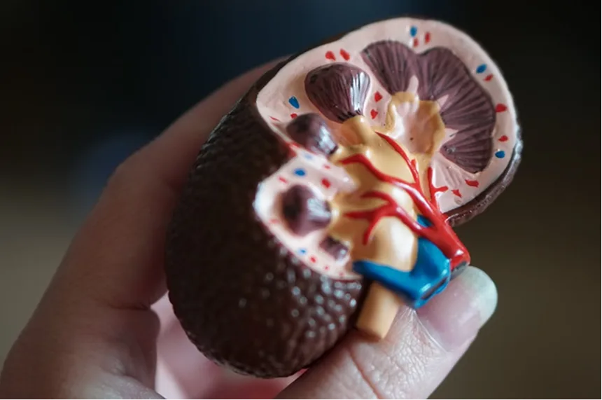 Kidney stone anatomical model showing stone formation
