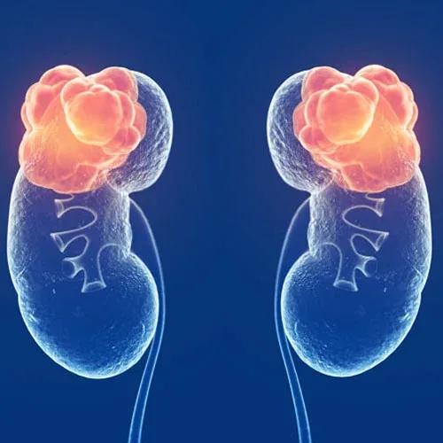 Urological Cancers - Urocare Hospital Gondia